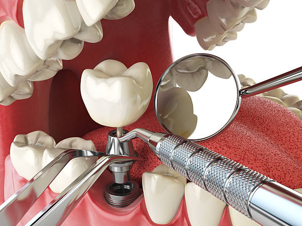 Best Same-Day Emergency Dentist in Glen Rose, TX